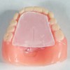 (3.) Gothic arch tracer assembly attached to the maxillary and mandibular dentures in preparation for fabrication of occlusal device.