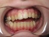 (3.) In children, mouth breathing with low tongue posture can result in narrow maxillary arches, dental crowding, tongue scalloping, and anterior open bites. Images courtesy of Kevin Boyd, DDS, MSc.