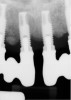 (1.) Periapical x-ray image showing clear demarcation of implant threads and visible bone loss characteristic of peri-implantitis.