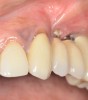 (2.) Lack of keratinized attached tissue on the buccal aspect of teeth Nos. 11 through 13, resulting in food impaction and detachment from the implant site.