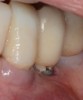 (4.) Recession around a dental implant caused by excess subgingival cement, which is now exposed because of the recession.